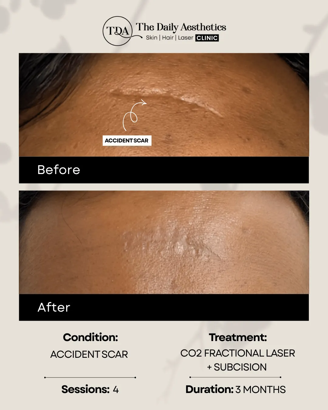 Accident Scar (CO2 Fractional Laser + Subcision)