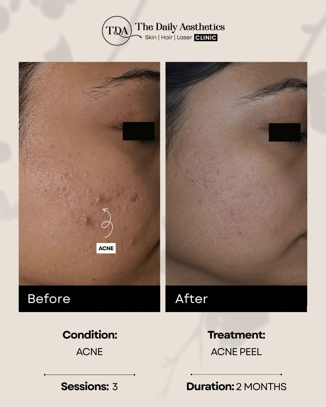 Acne (Acne Peel Treatment) 2