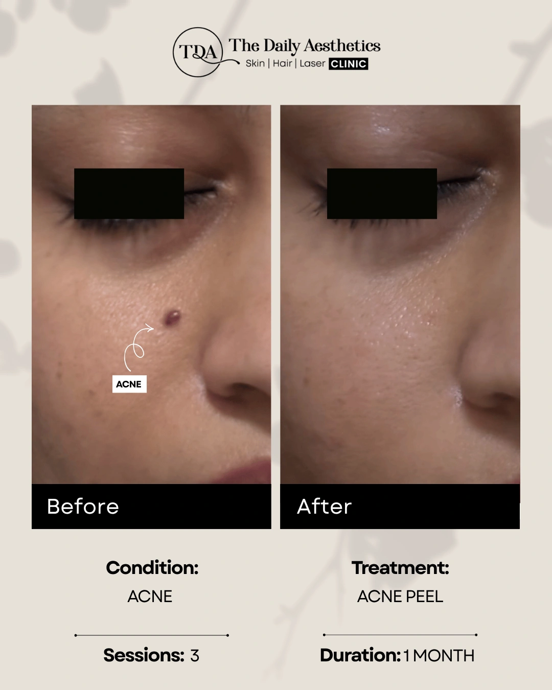 Acne (Acne Peel Treatment)