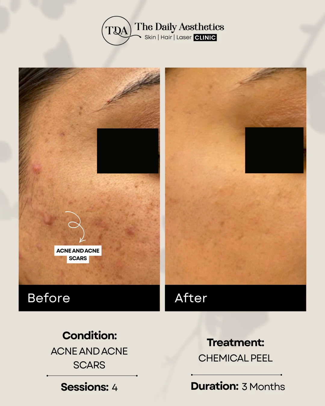 Acne & Acne Scars (Chemical Peel)