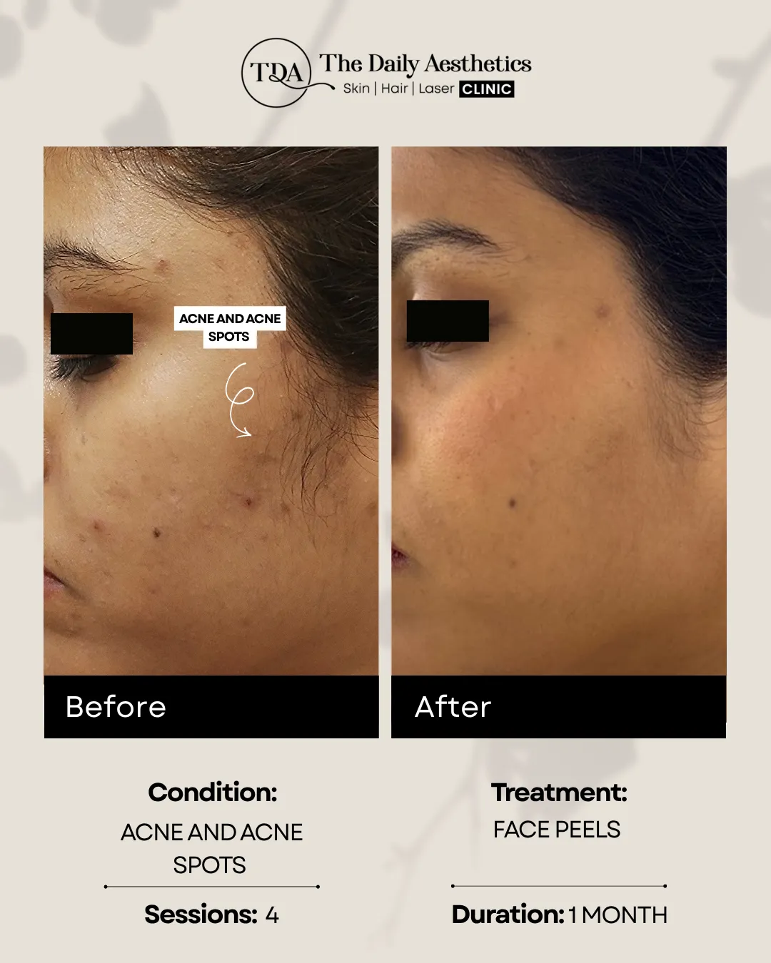 Acne And Acne Spots (Face Peels Treatment)