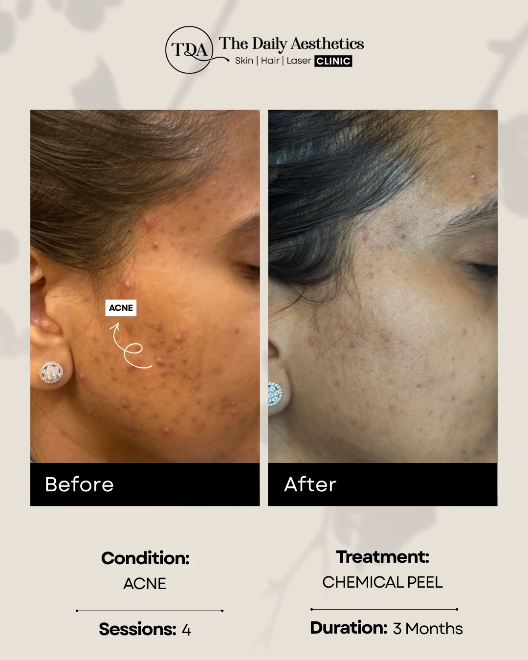Acne (Chemical Peel Treatment)