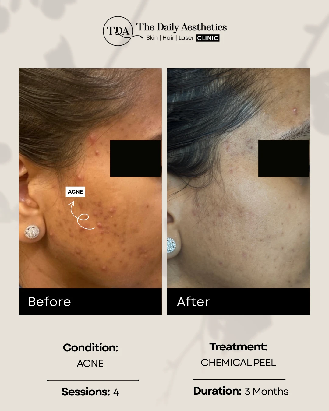 Acne (Chemical Peel)