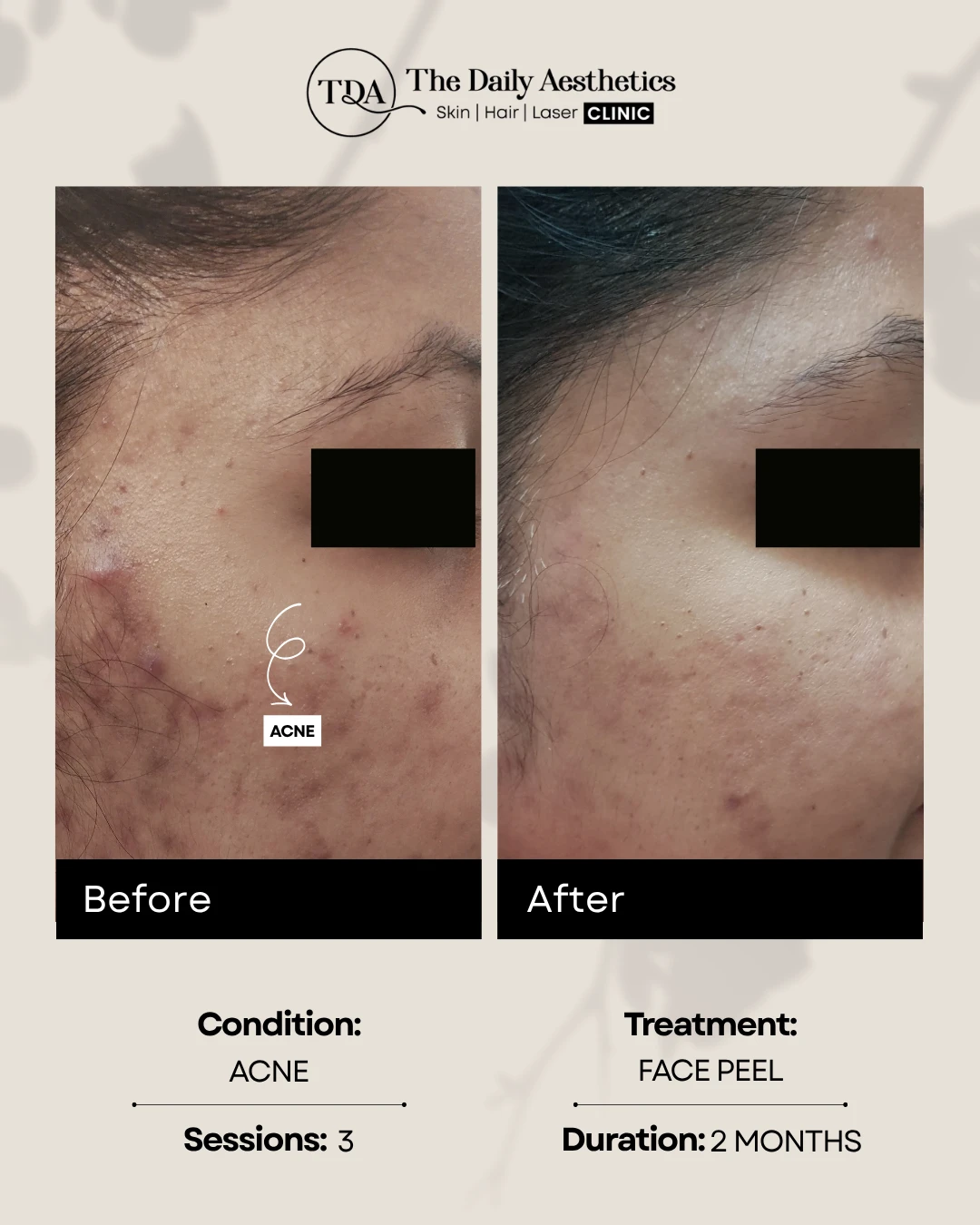 Acne (Face Peel) (2)