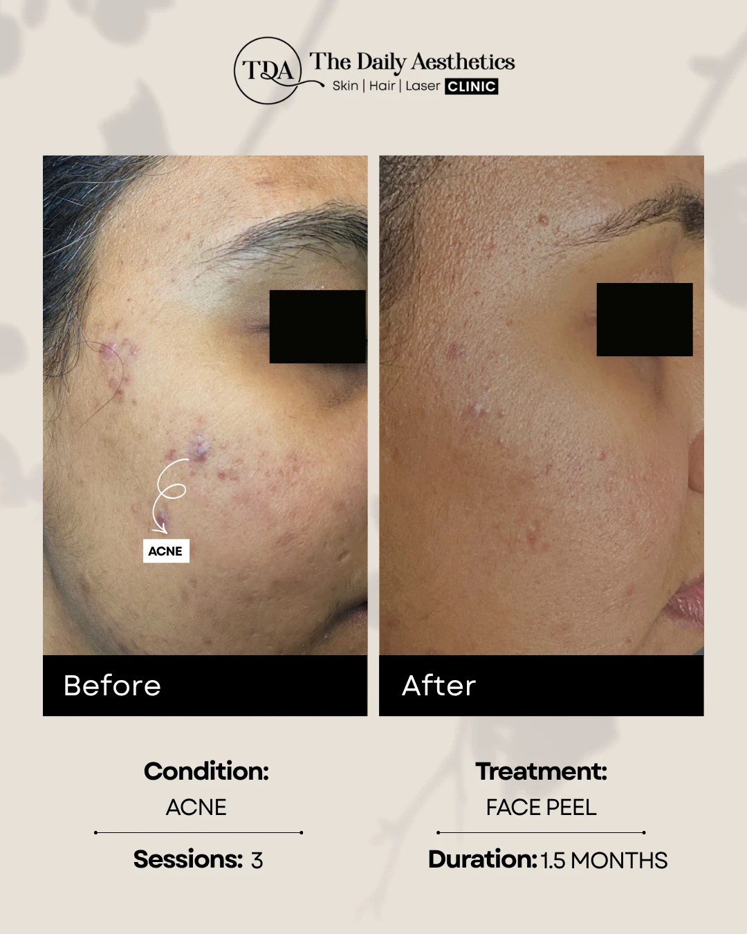 Acne (Face Peel Treatment)