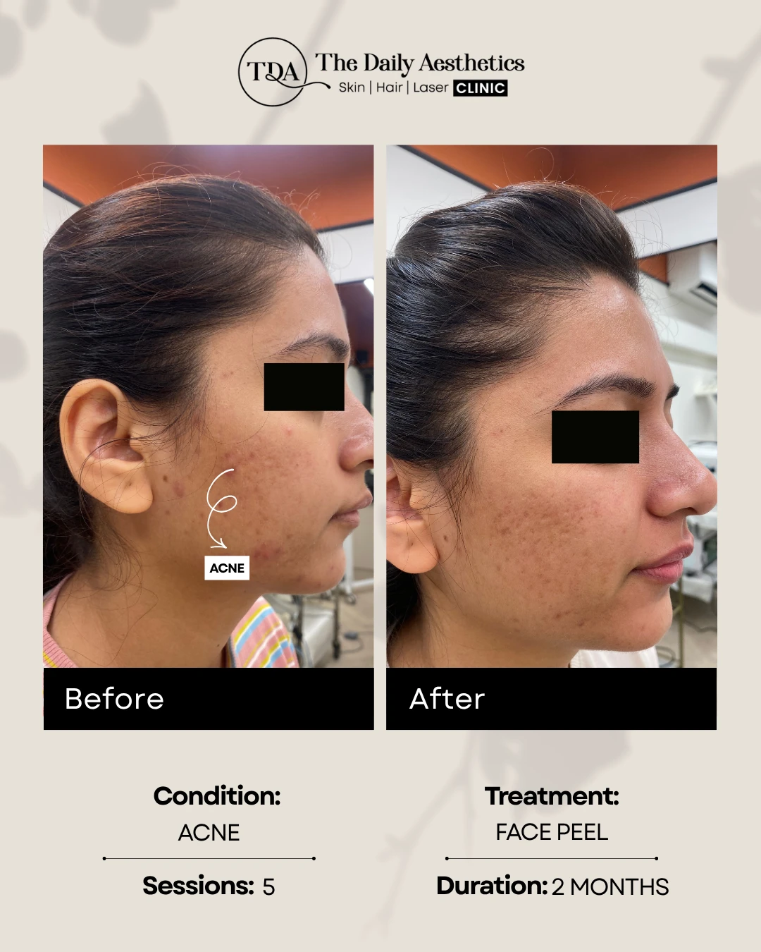 Acne (Face Peel)