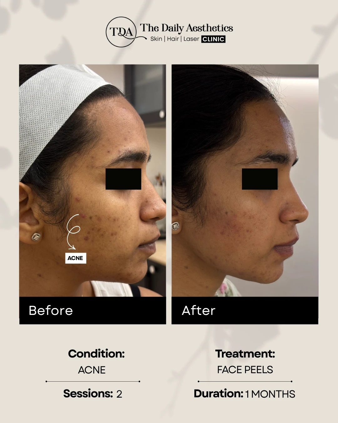 Acne (Face Peels) (2)