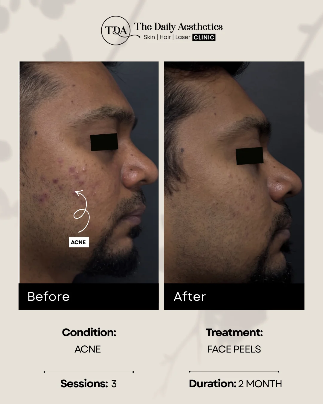 Acne (Face Peels Treatment)