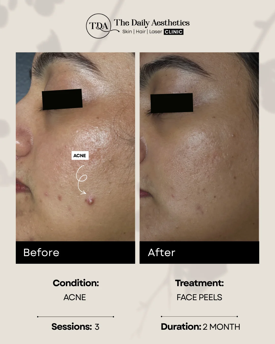 Acne (Face Peels Treatment) 2