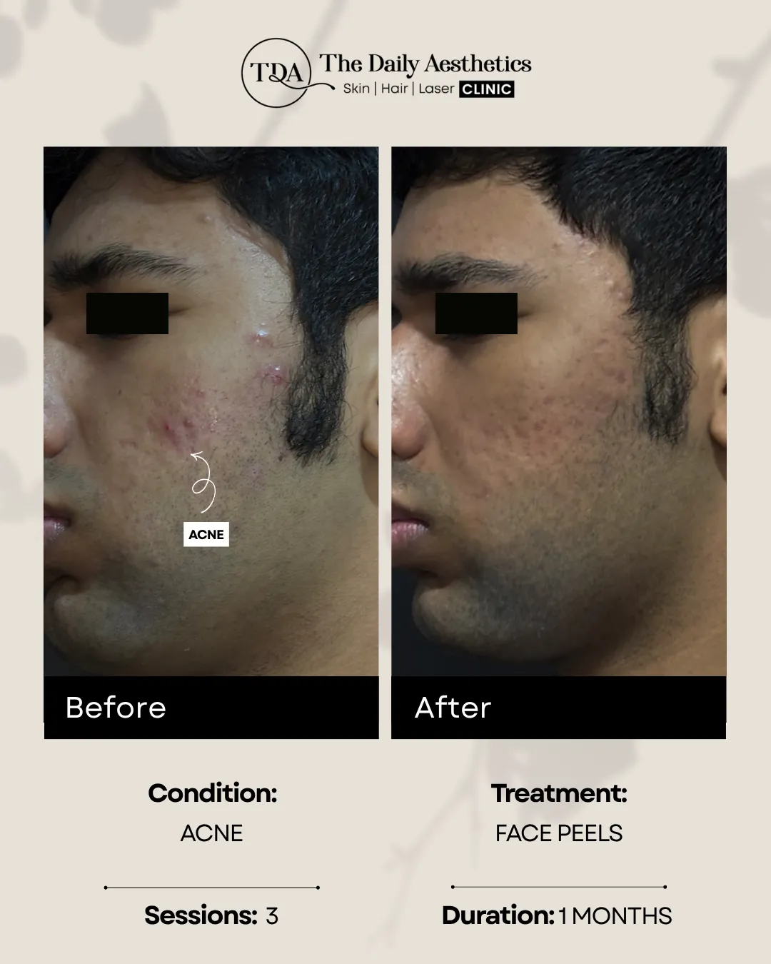 Acne (Face Peels Treatment) (2)