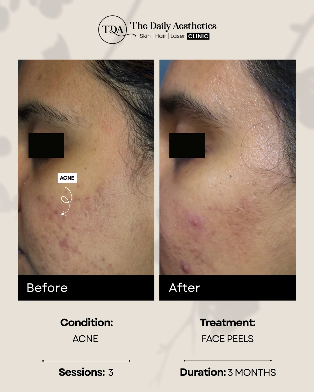 Acne (Face Peels Treatment)