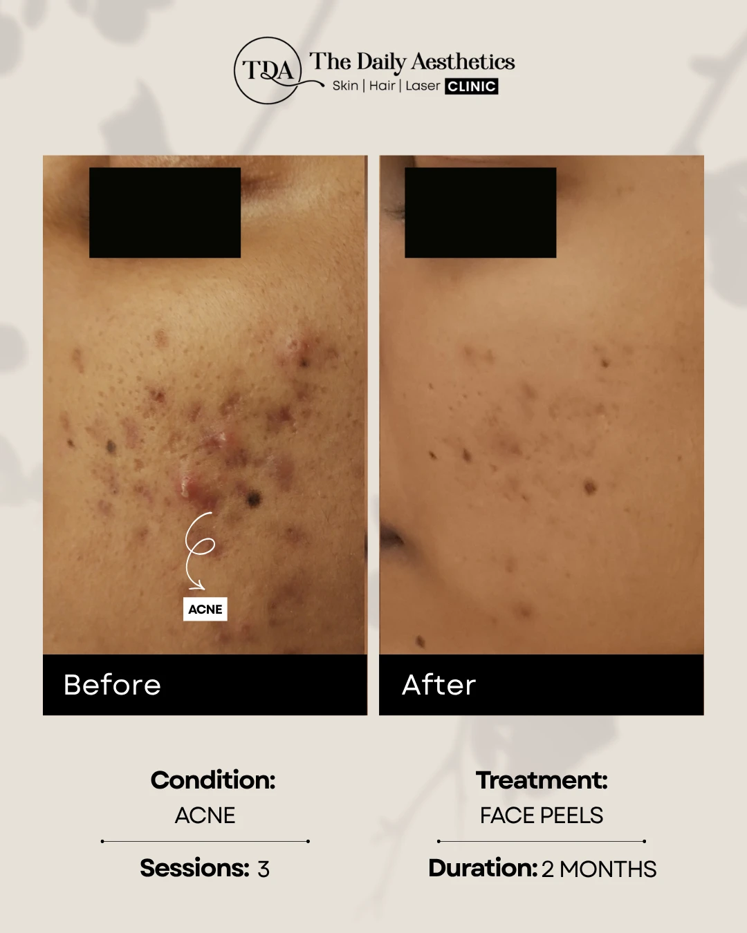 Acne (Face Peels)
