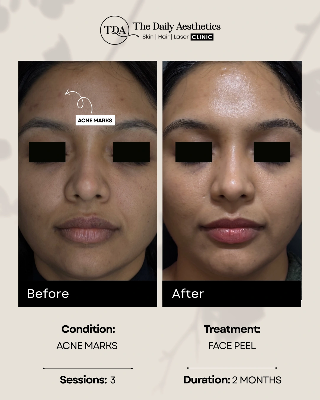 Acne Marks (Face Peel Treatment)