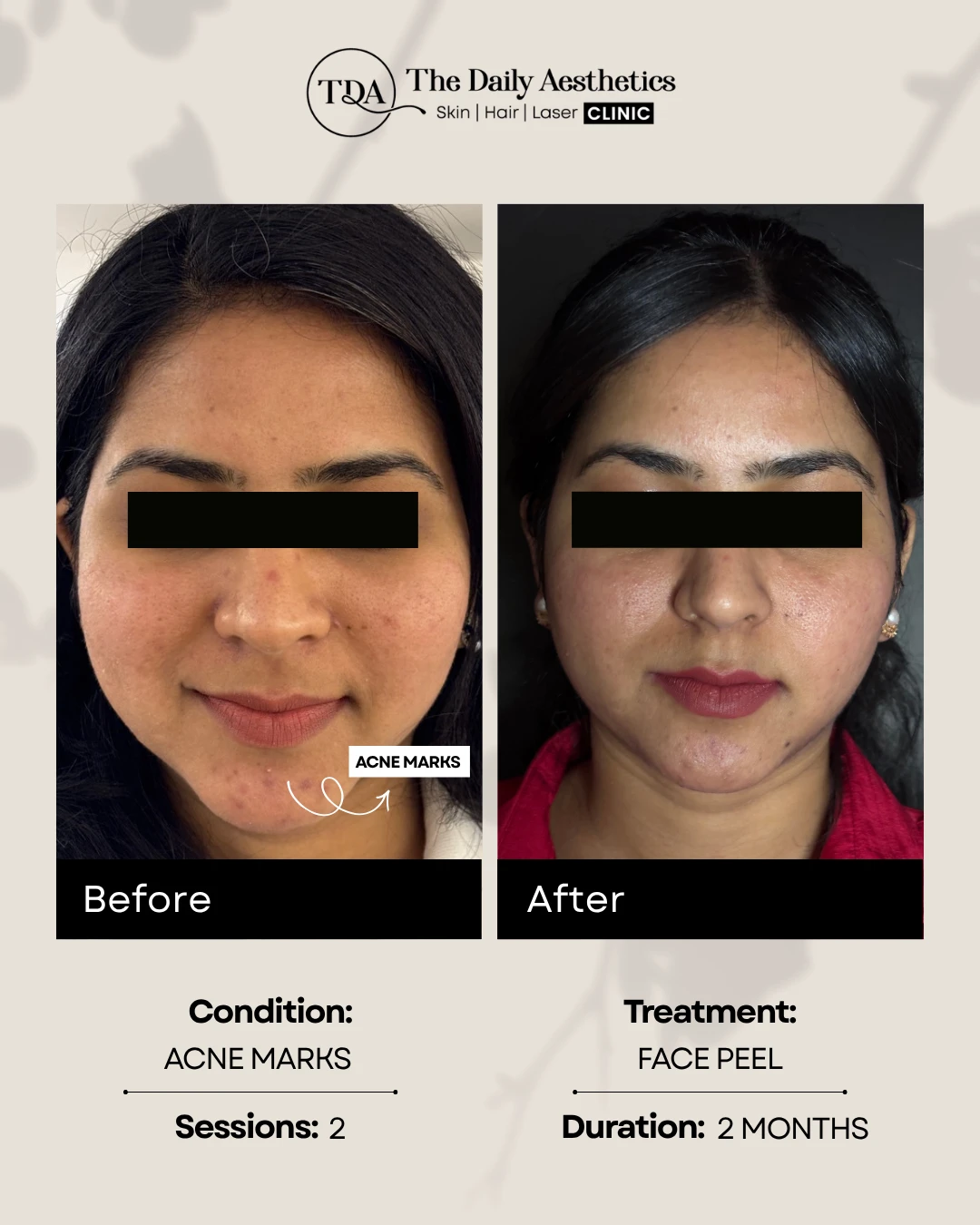 Acne Marks (Face Peel Treatment)