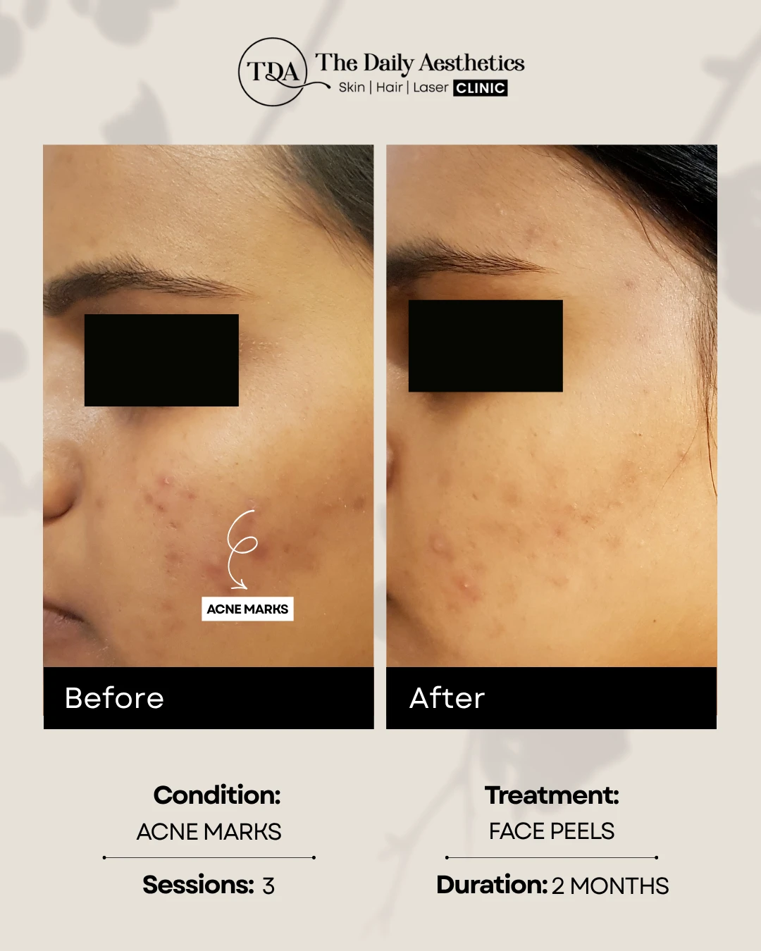 Acne Marks (Face Peels) (2)