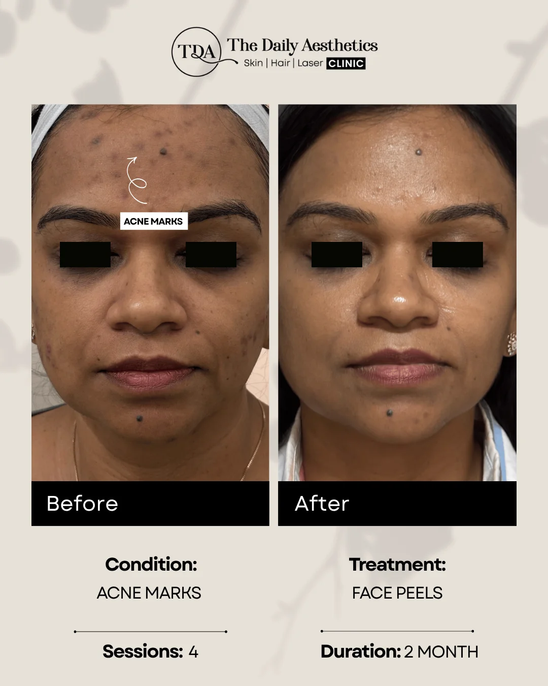 Acne Marks (Face Peels Treatment)