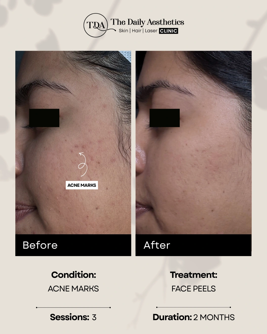 Acne Marks (Face Peels Treatment)