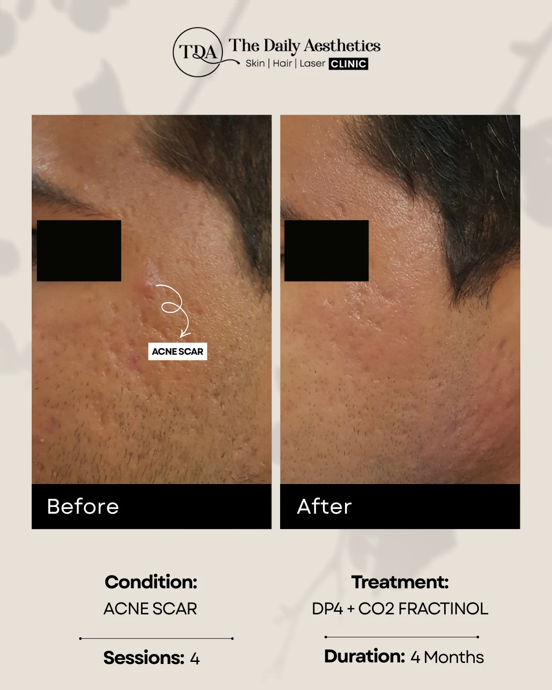 Acne Scar (DP4 + CO2 Fractinol)
