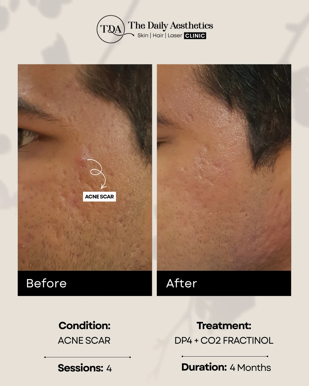 Acne Scar (DP4 + CO2 Fractional Treatment)