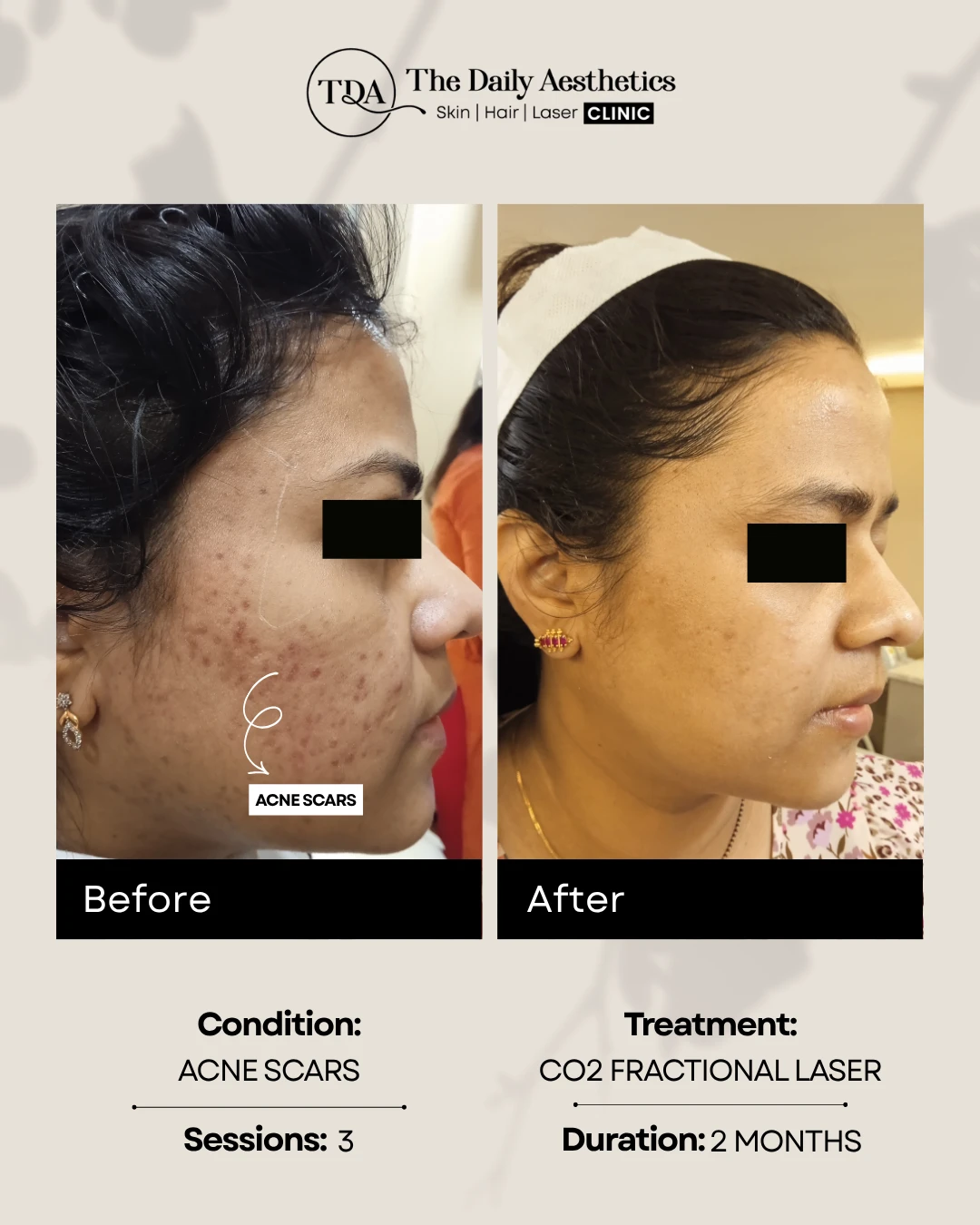 Acne Scars (CO2 Fractional Laser)