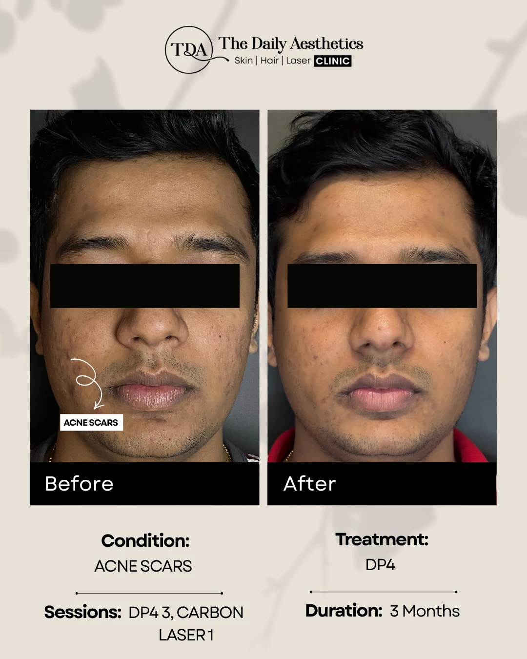 Acne Scars (DP4 + Carbon Laser Treatment)