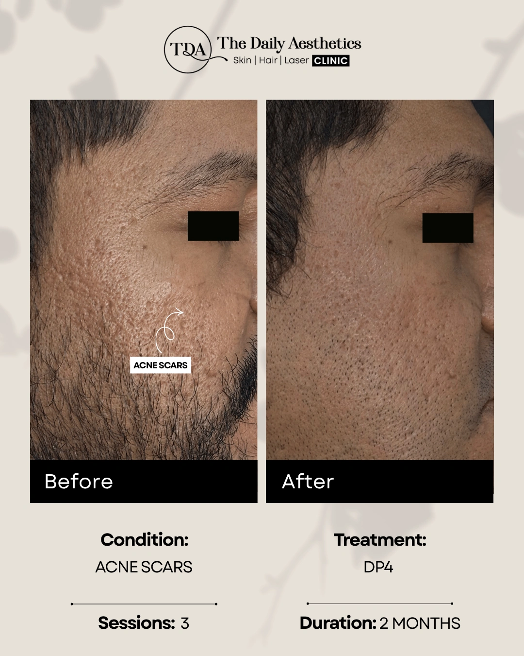 Acne Scars (DP4 Treatment)