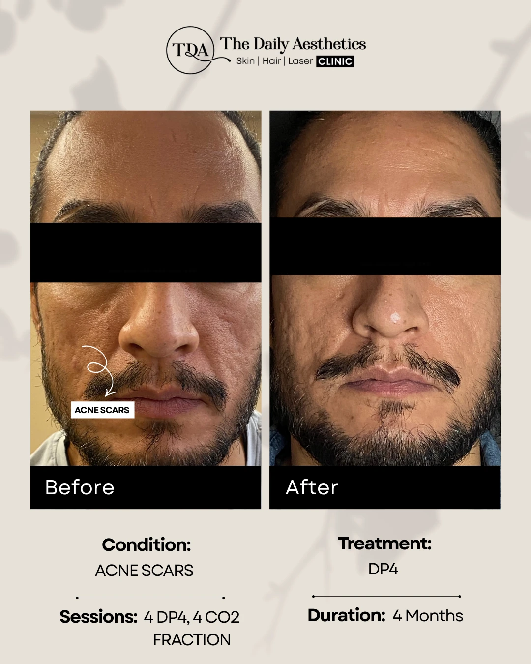 Acne Scars (DP4 Treatment)