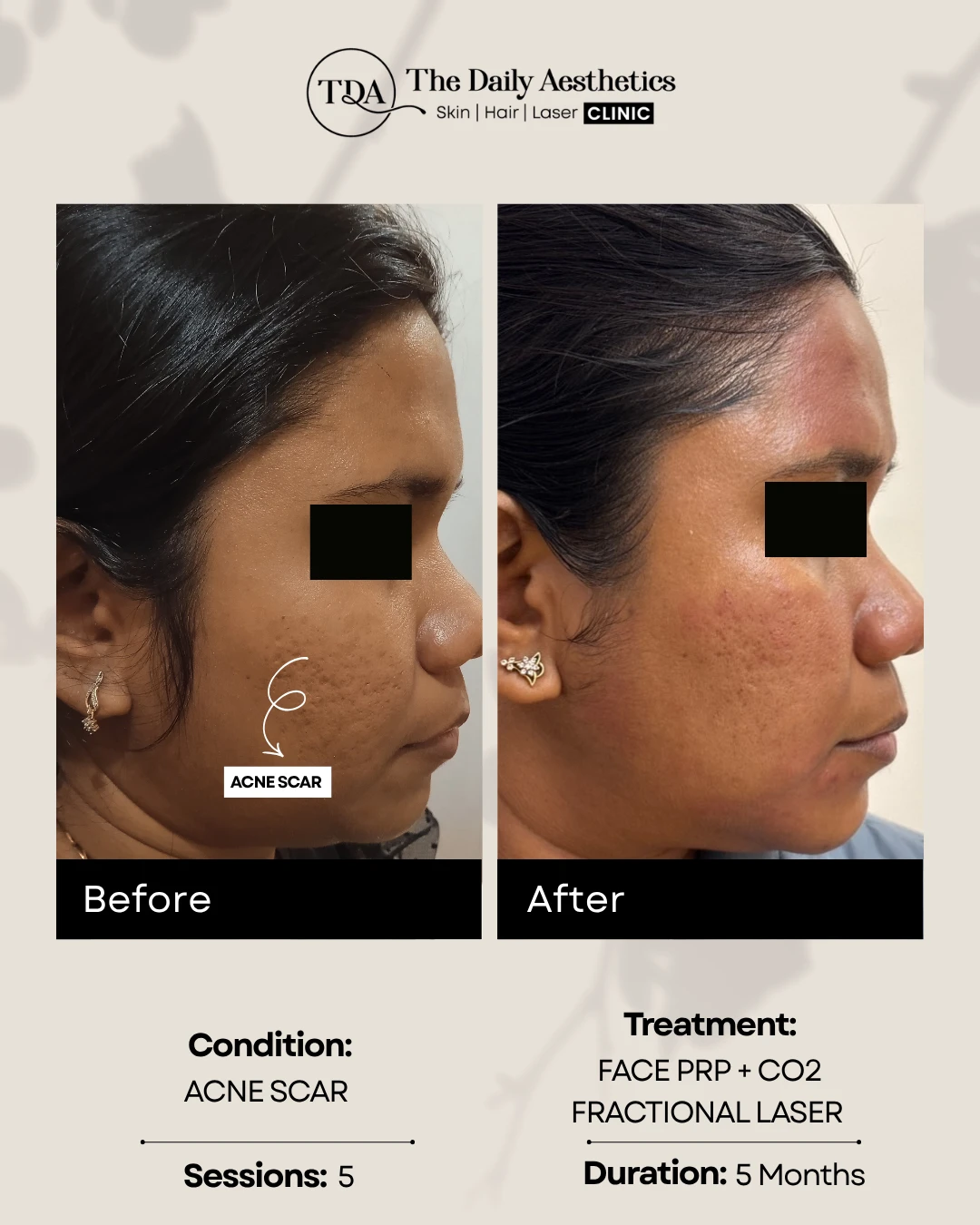 Acne Scars (Face PRP + CO2 Fractional Laser Treatment)