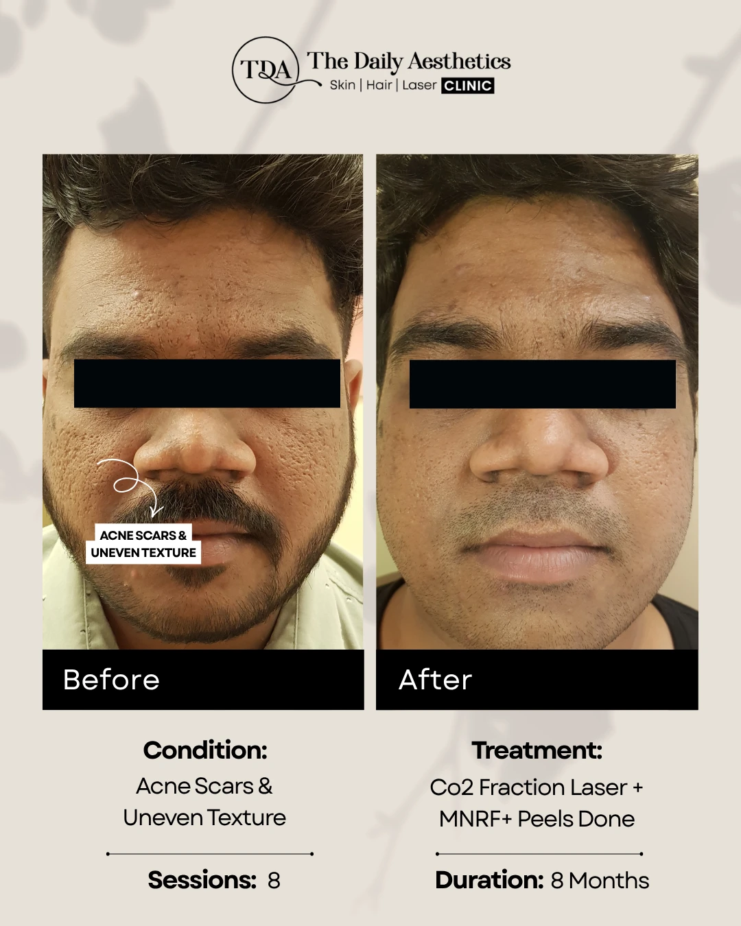 Acne Scars & Uneven Texture (CO2 Fraction Laser + MNRF + Peels)