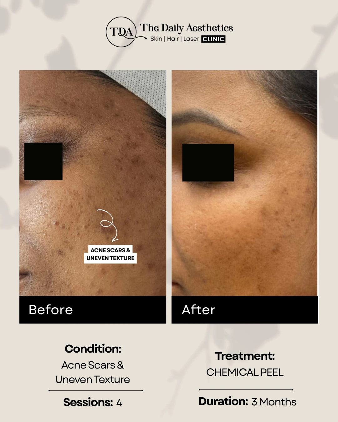 Acne Scars & Uneven Texture (Chemical Peel Treatment)