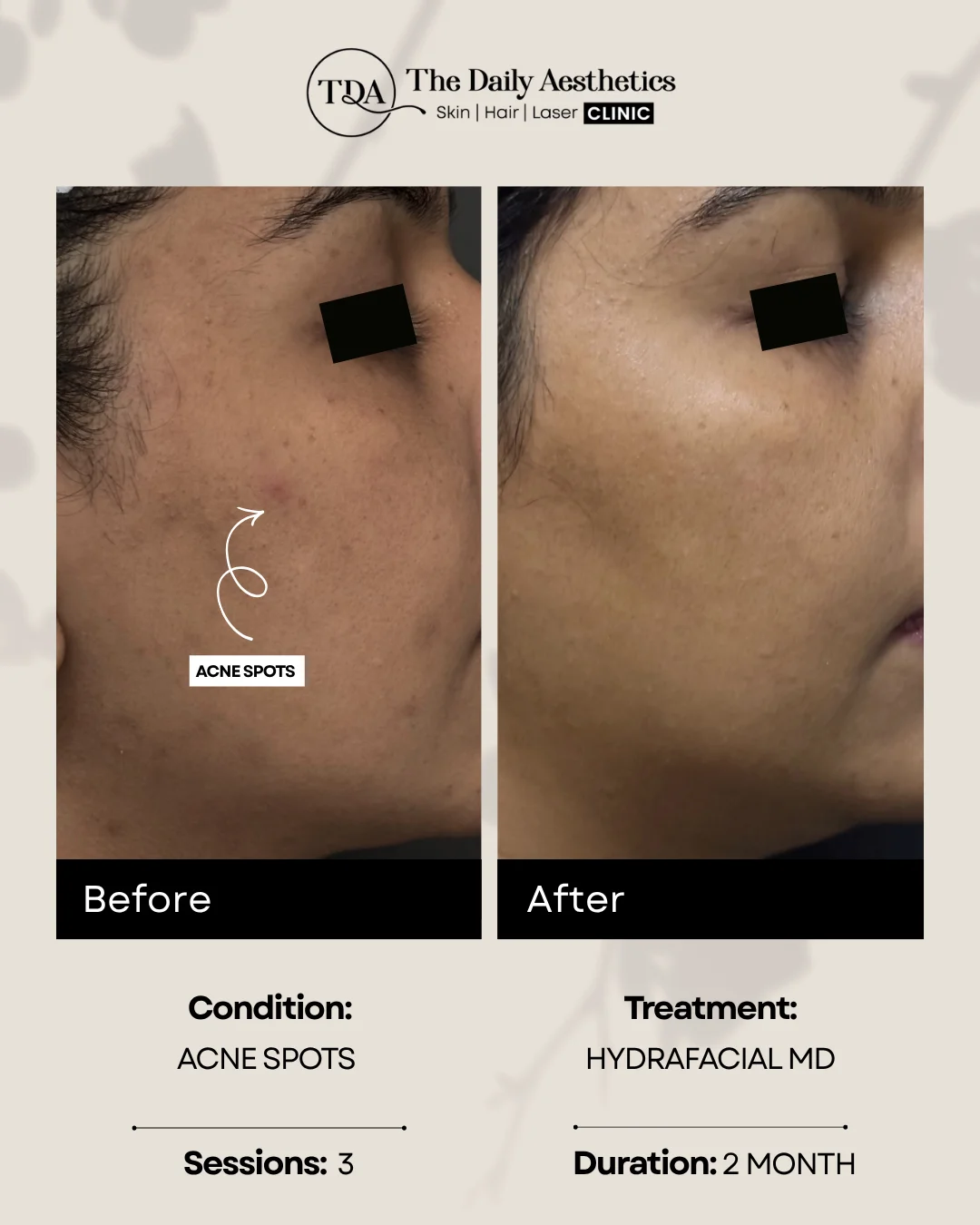 Acne Spots (Hydrafacial MD Treatment)