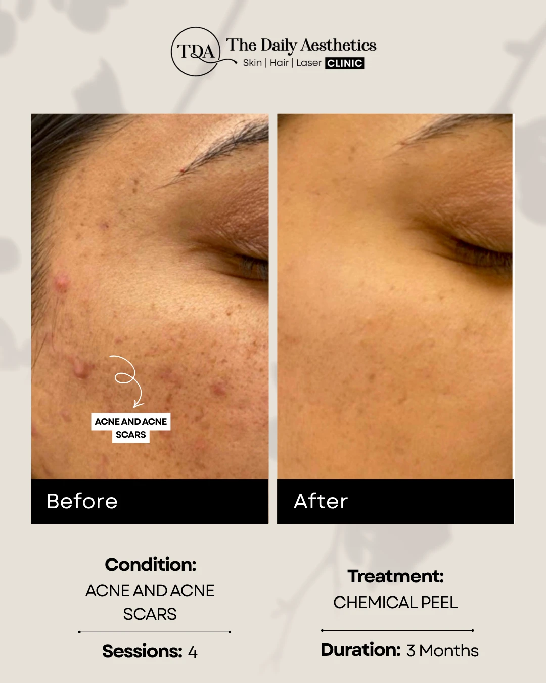 Acne and Acne Scars (Chemical Peel Treatment)