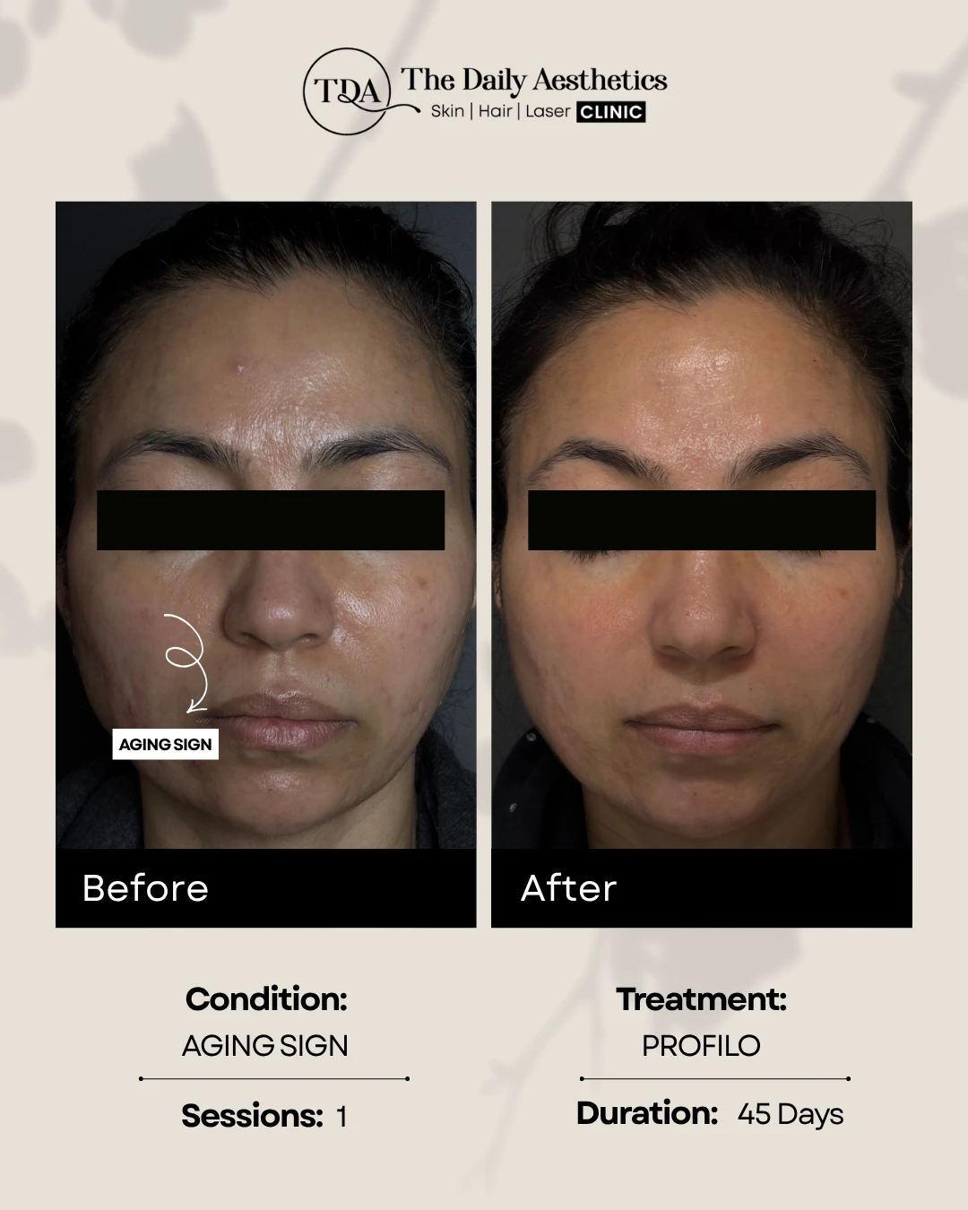Aging Sign (Profilo Treatment)