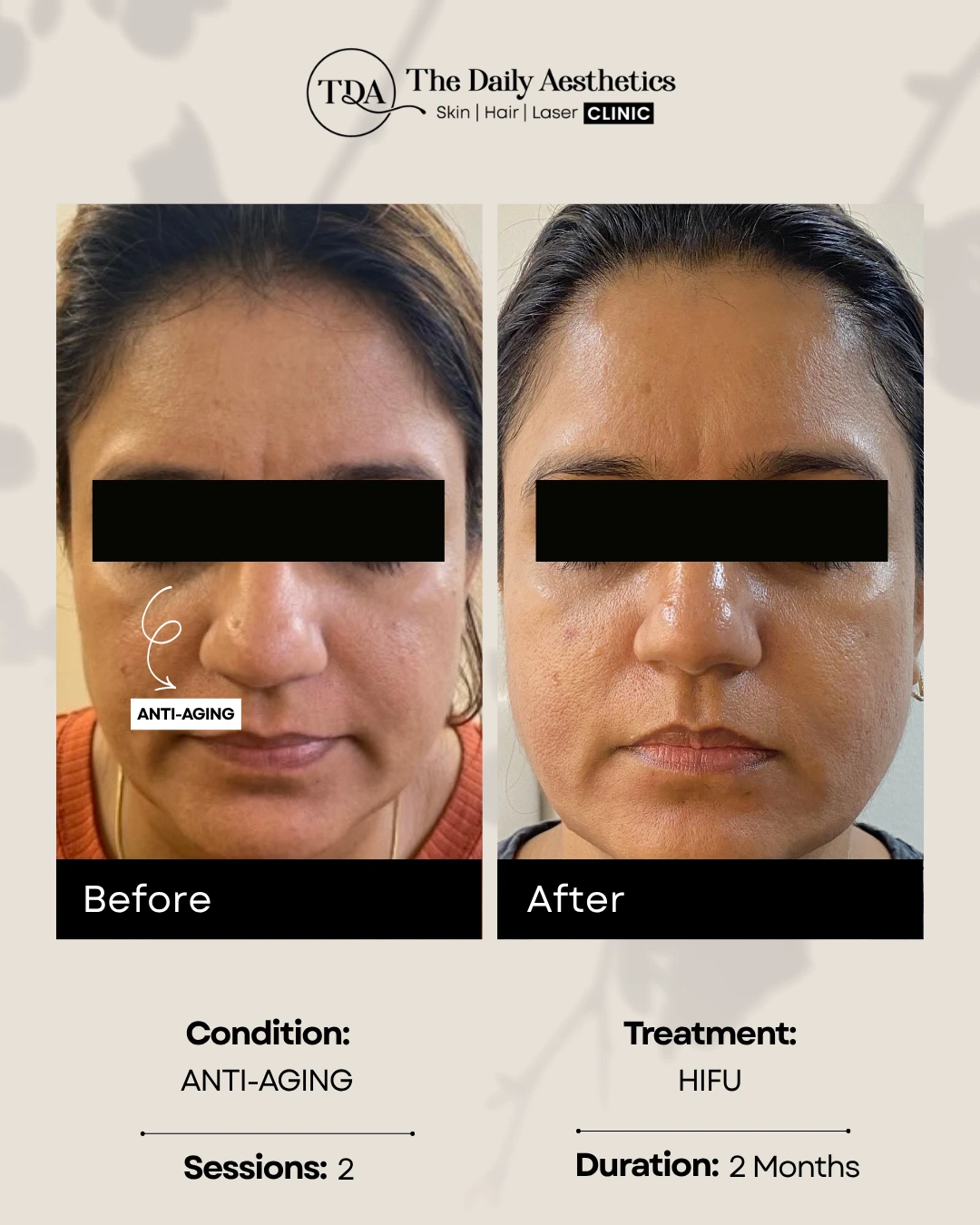 Anti-Aging (HIFU Treatment) (2)