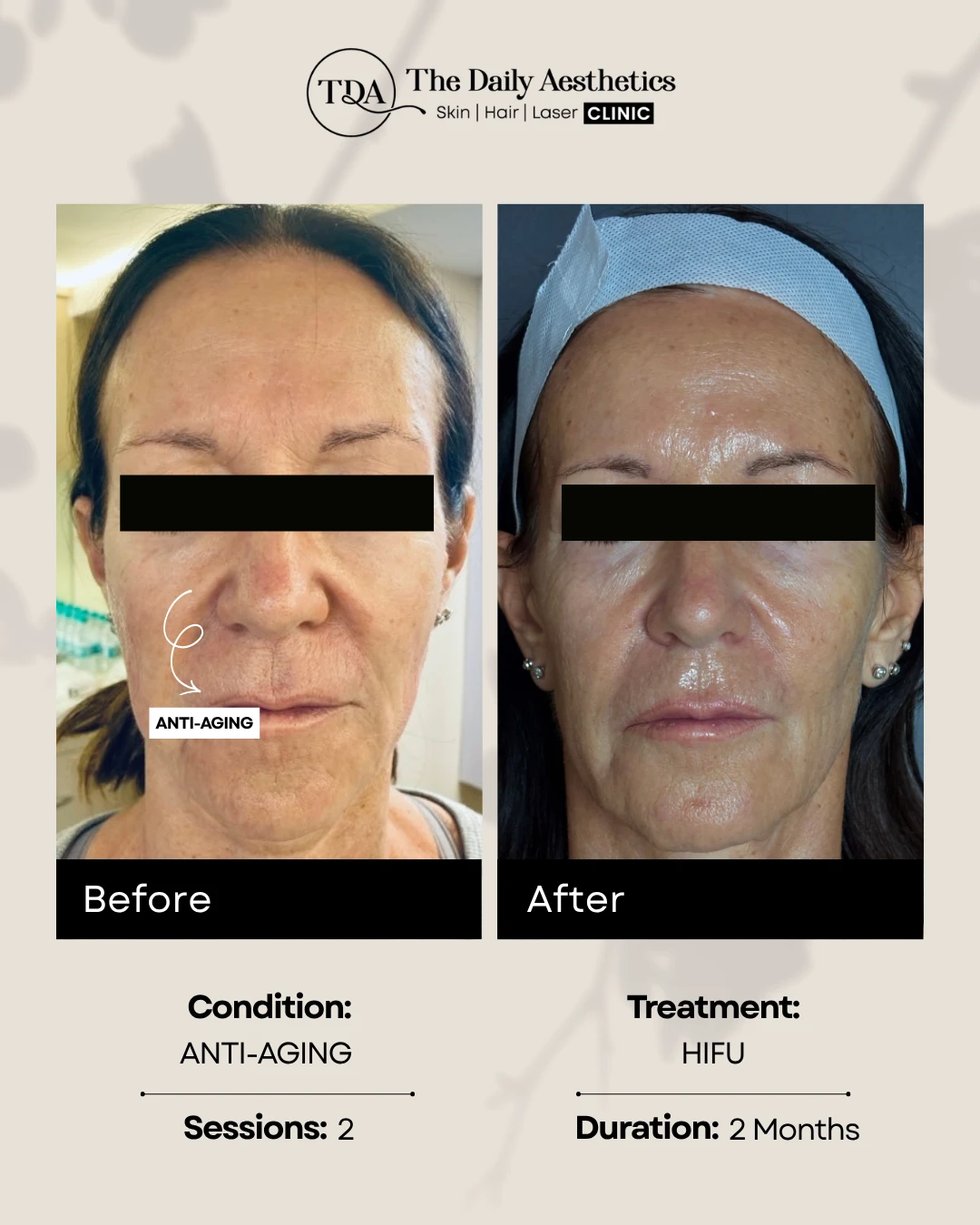 Anti-Aging (HIFU Treatment) (3)