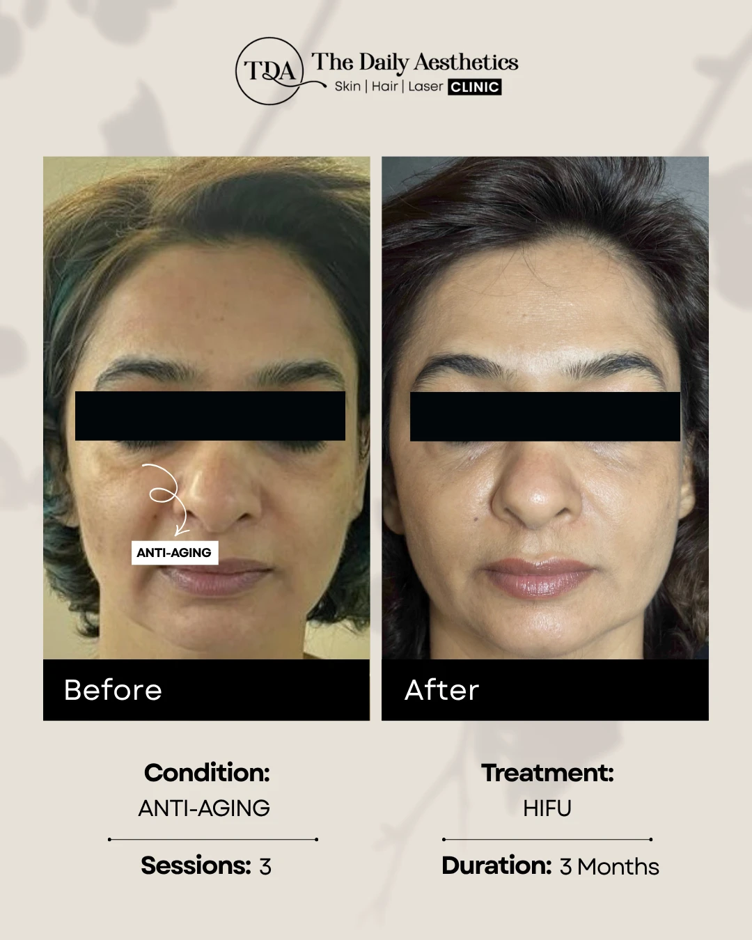 Anti-Aging (HIFU Treatment)