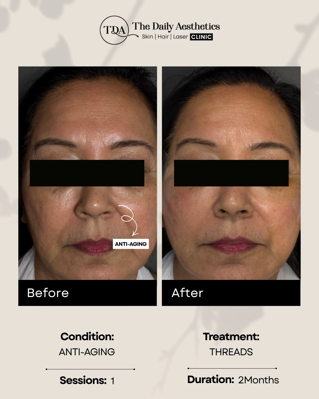 Anti-Aging (Threads Treatment) (2)
