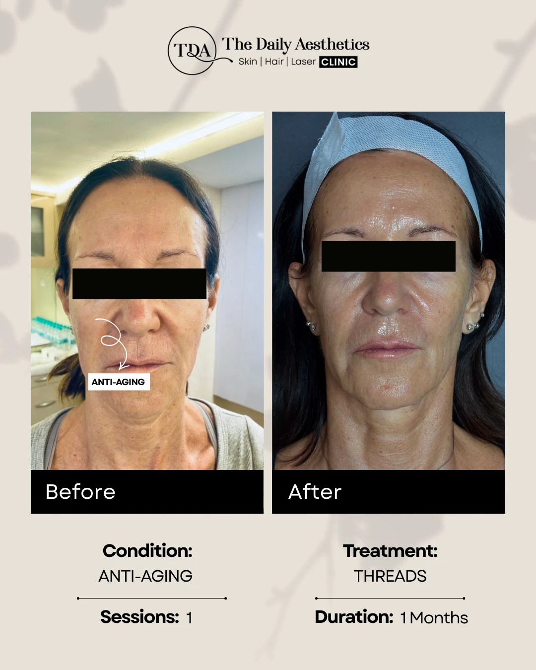Anti-Aging (Threads Treatment)