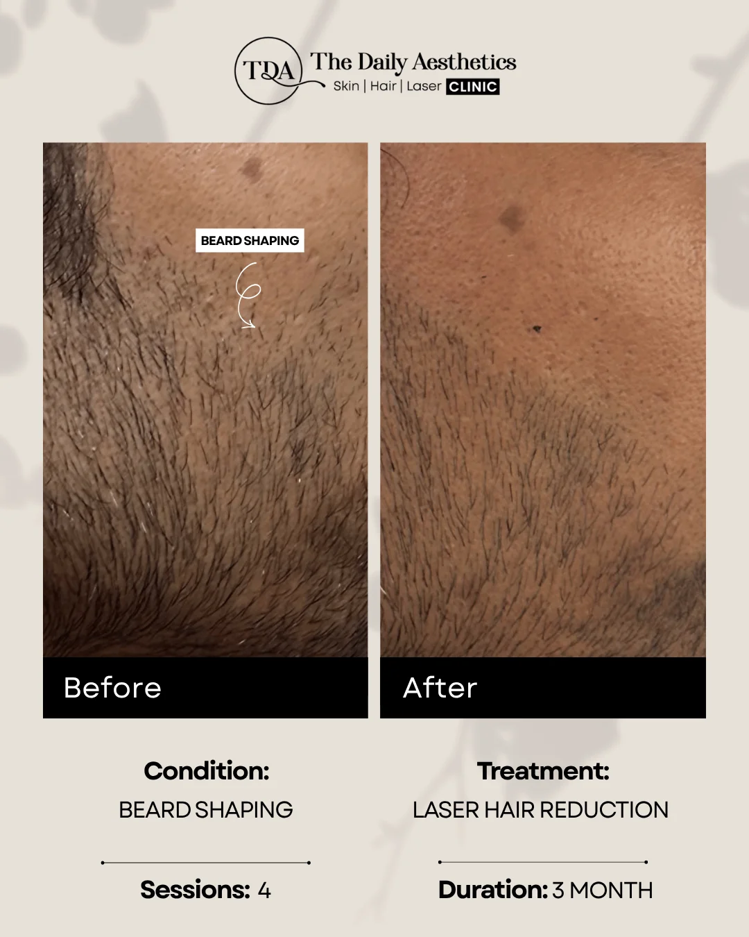Beard Shaping (Laser Hair Reduction Treatment)