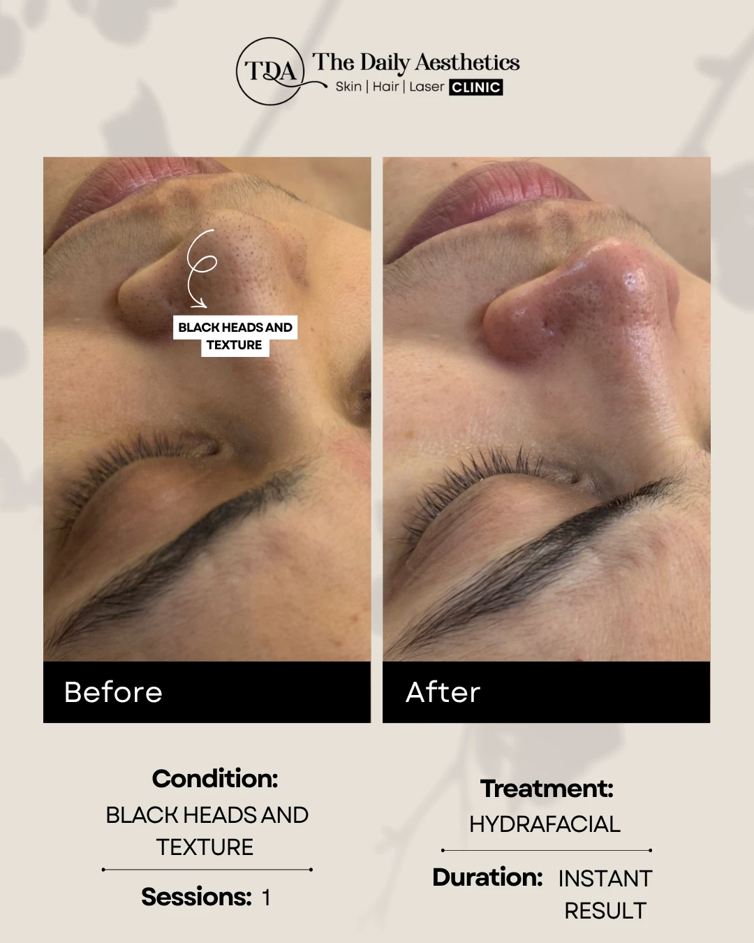 Black Heads & Texture (Hydrafacial Treatment)