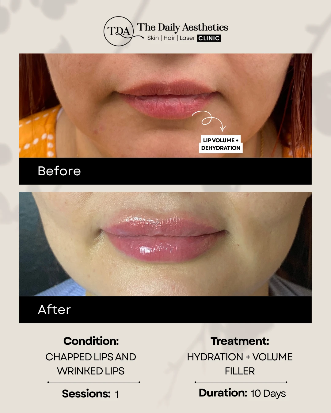 Chapped Lips and Wrinked Lips (Hydration Filler Treatment)