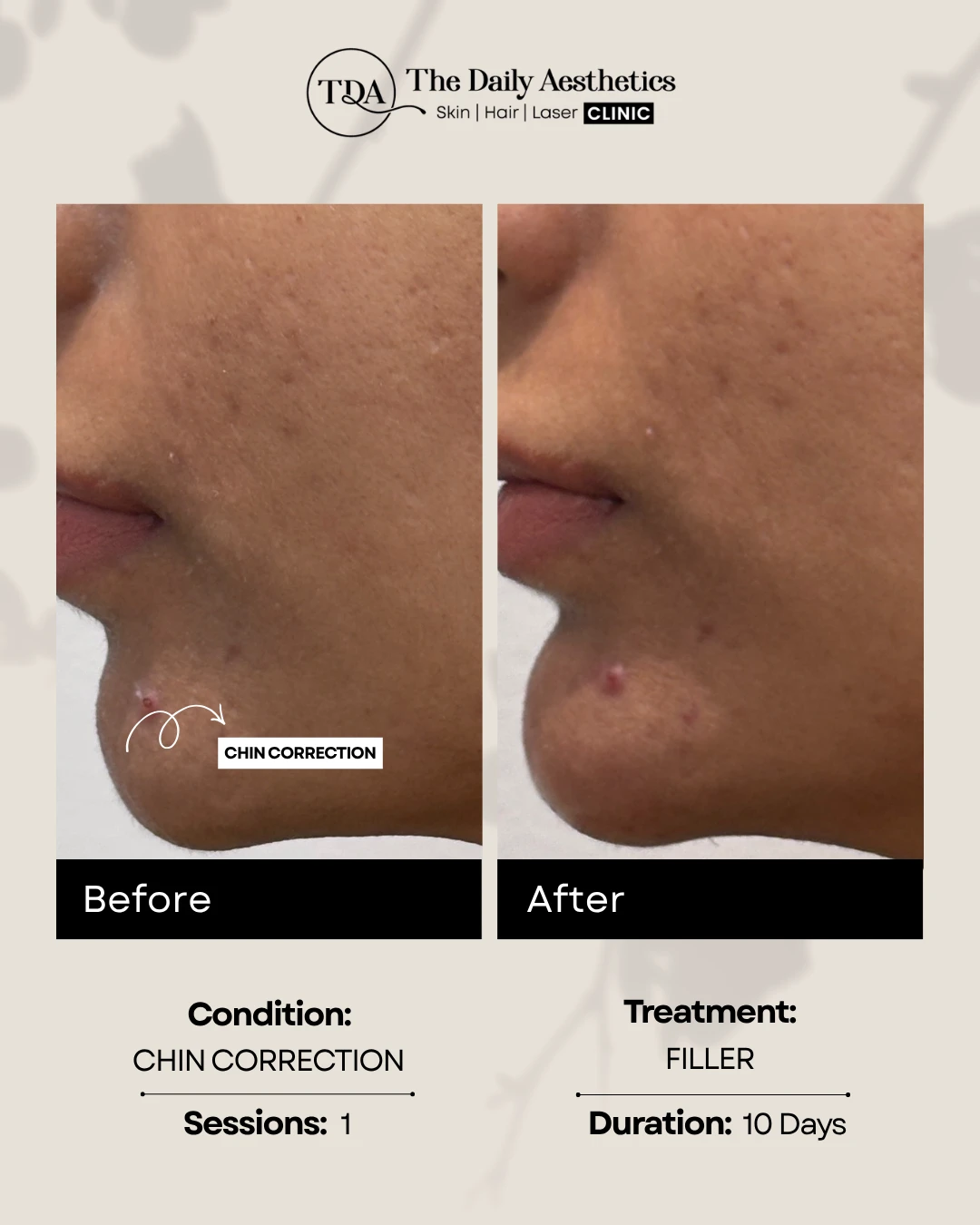 Chin Correction (Filler Treatment)