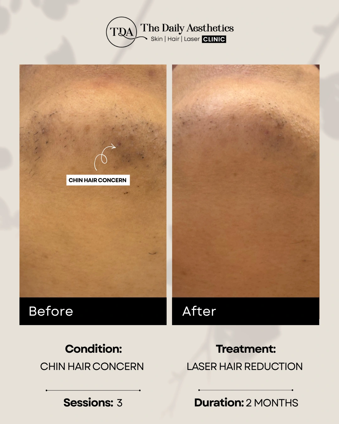 Chin Hair Concern (Laser Hair Reduction Treatment)