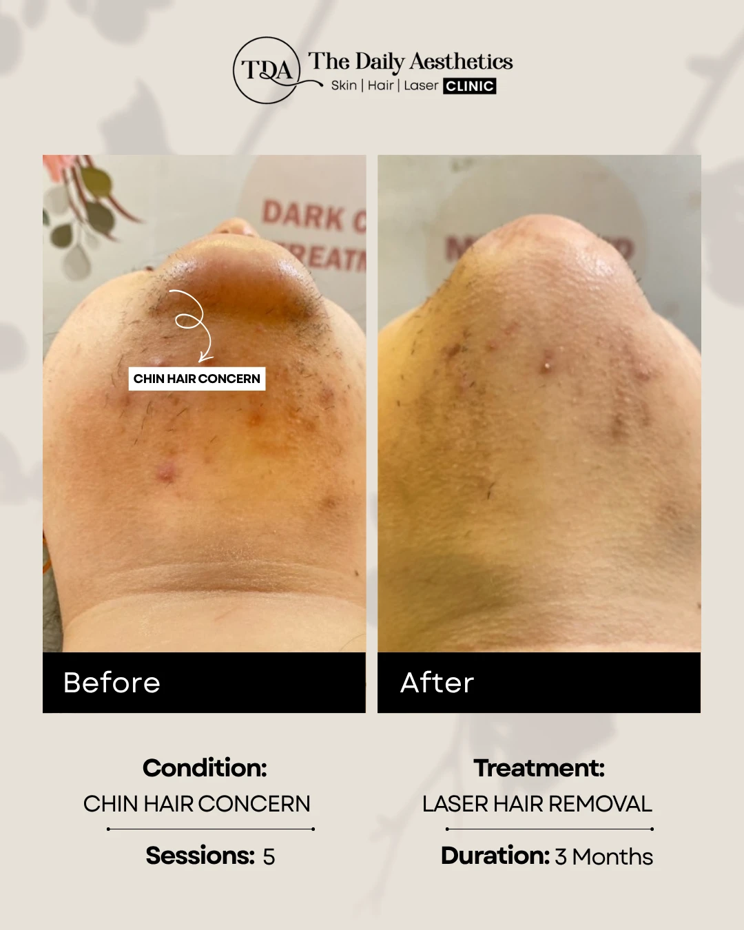 Chin Hair Concern (Laser Hair Removal Treatment)