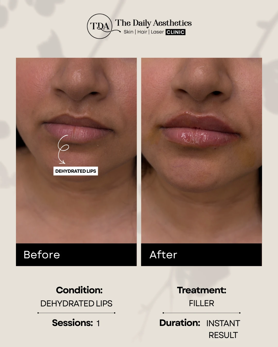Dehydrated Lips (Filler) (2)