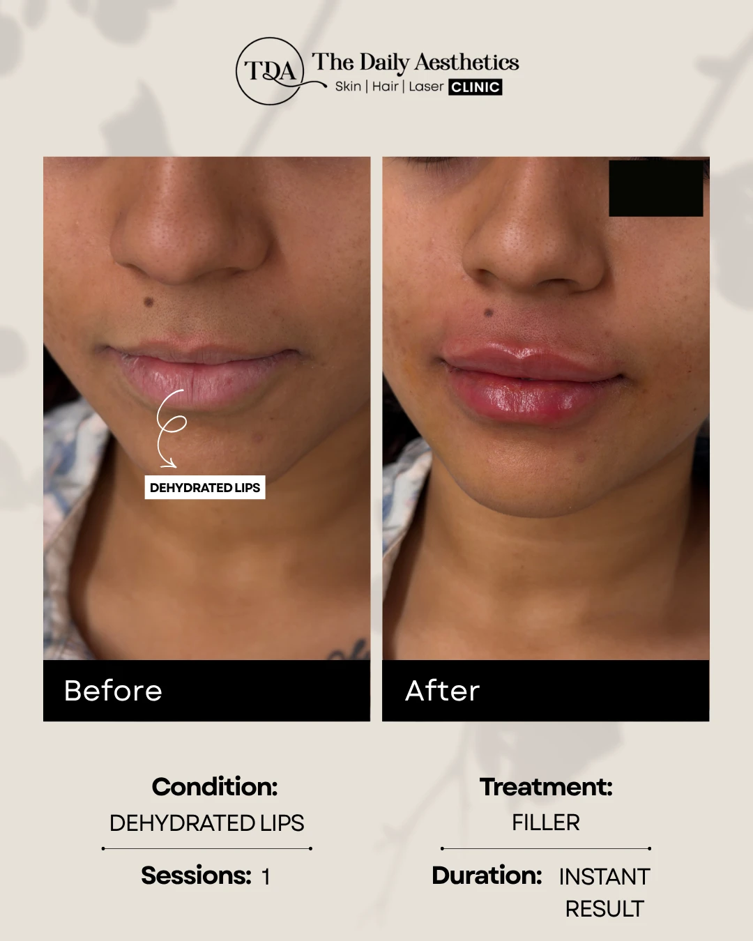 Dehydrated Lips (Filler)