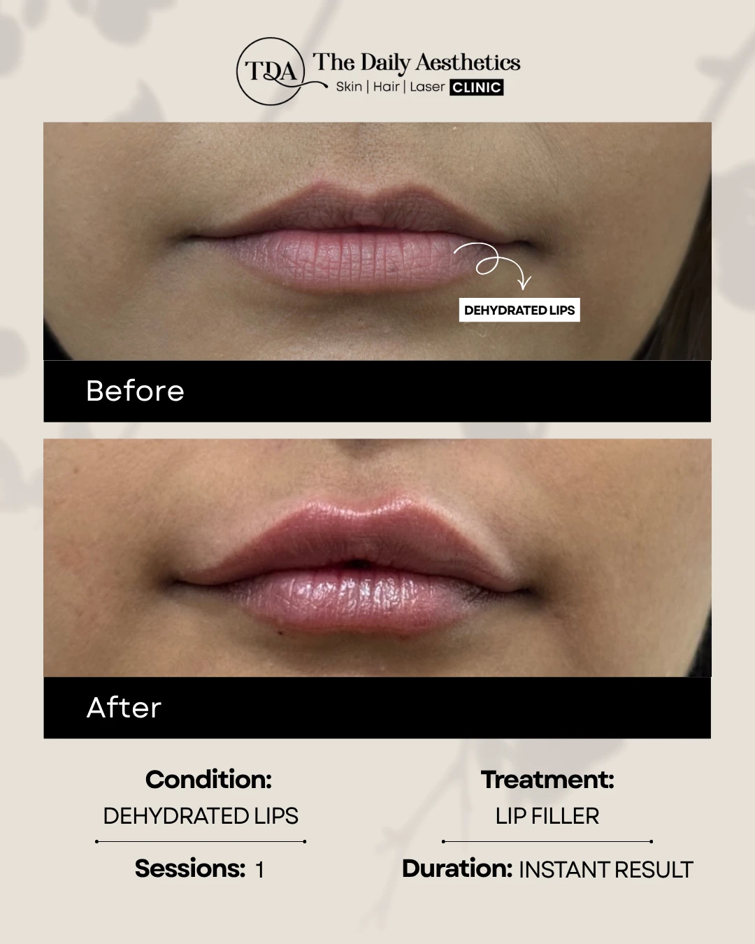 Dehydrated Lips (Lip Filler Treatment) (2)