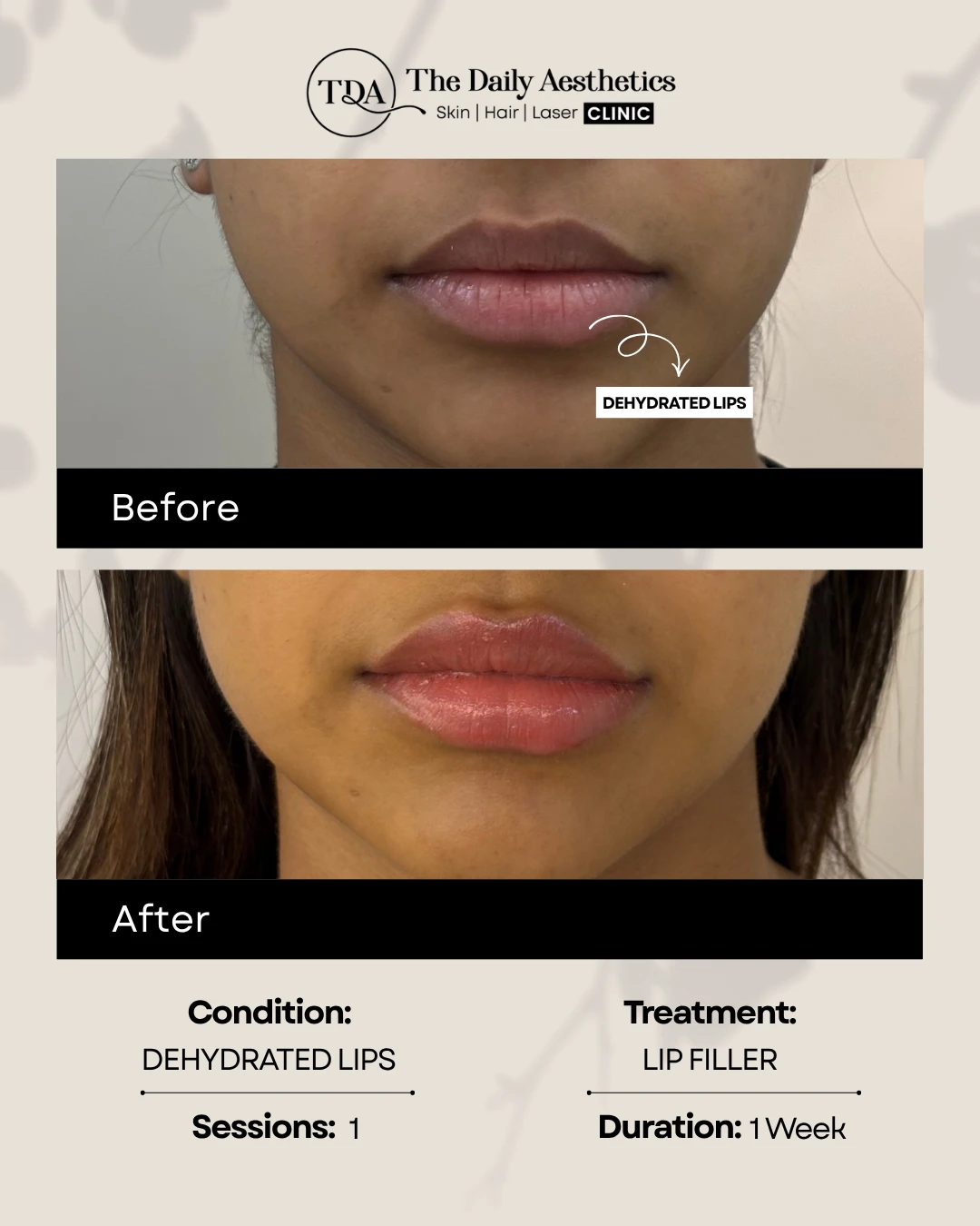 Dehydrated Lips (Lip Filler Treatment)