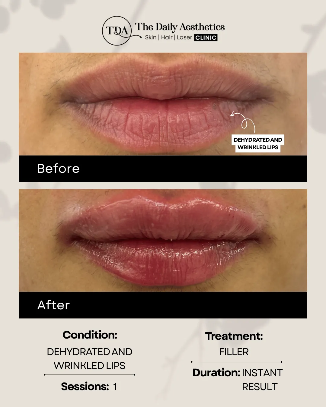 Dehydrated and Wrinkled Lips (Filler)