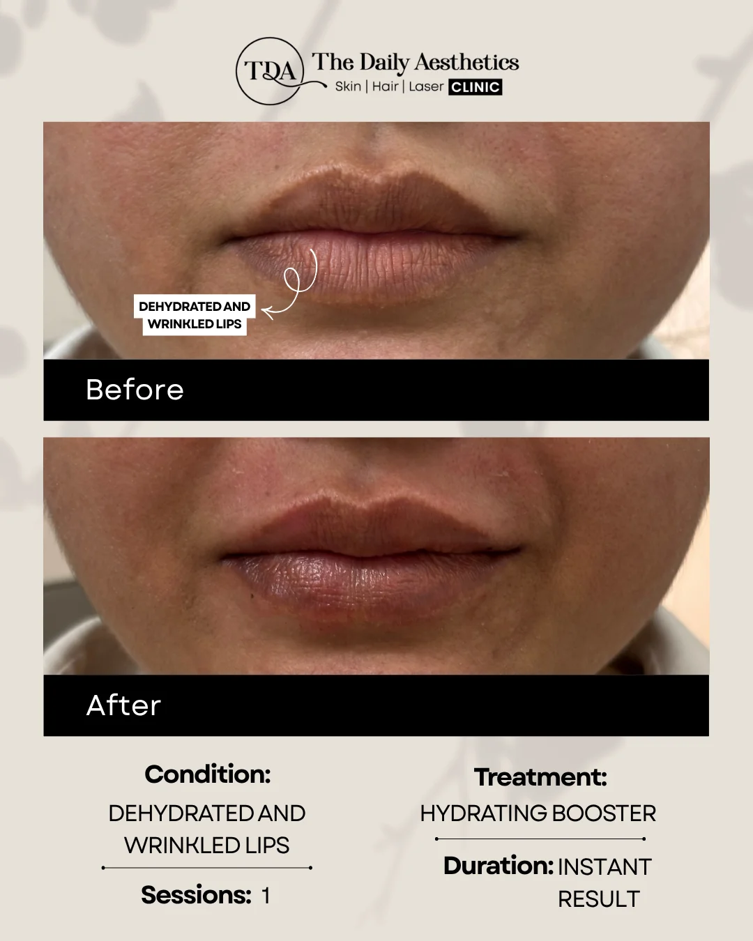 Dehydrated and Wrinkled Lips (Hydration Booster)
